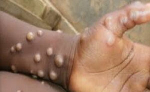 tracmpox