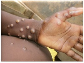 Image courtesy of the Nigeria Centre for Disease Control