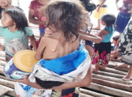 Venezuelan migrants seeking medical treatment at Port Kaituma