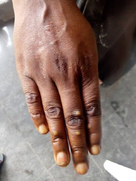 Monkeypox patient. (Courtesy: Akwa Ibom Ministry of Health)